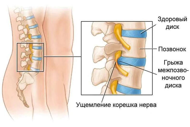 Защемление нерва в спине поясница. Межпозвоночная грыжа грыжа поясничного отдела. Грыжа позвонка поясничного отдела. Грыжа позвоночника защемление нерва. Межпозвоночные диски пояснично крестцового отдела.