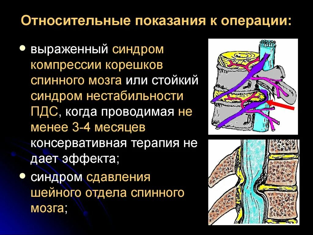 Причины сдавления Корешков спинного мозга. Синдром компрессии 1 поясничного корешка. Компрессия s1 корешка позвоночника.. . Причина компрессии Корешков спинного мозга. Грыжа показания к операции