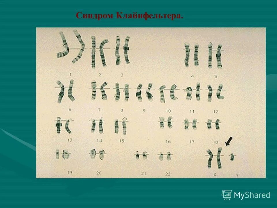 Синдром клайнфельтера кариотип. Основные клинические симптомы синдрома клайнфельтера:. Хромосомный набор клайнфельтера. Хромосомный набор клайнфельтера. Хромосомный набор клайнфельтера.