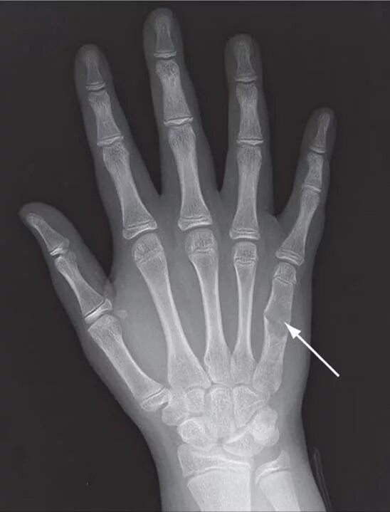 Энхондрома пястной кости. Энхондрома фаланги пальца рентген. Энхондрома пястной кости рентген. Опухоль пястной кости рентген.