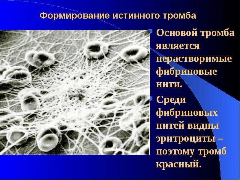 Значение тромба. Что является основой тромба. основу тромба составляет. чо является основной тромба.