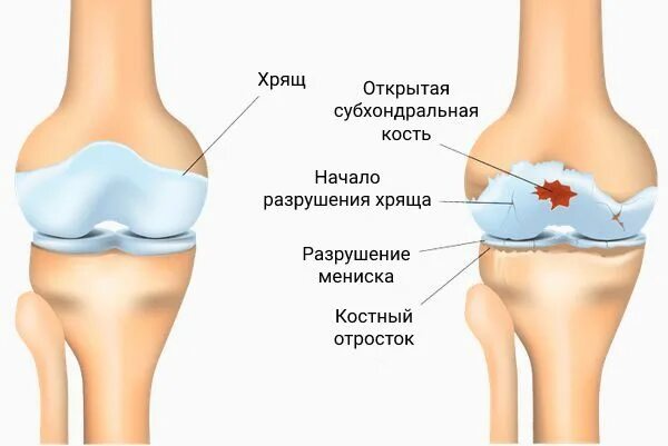 Истончены суставные хрящи. Суставной хрящ коленного сустава. Синовиальная оболочка сустава. Тазобедренный сустав анатомия коксартроз. Истончены суставные хрящи.