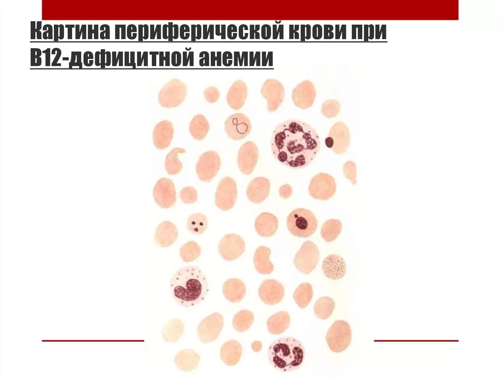 Для в12 дефицитной анемии характерно наличие. В12 дефицитная анемия периферическая кровь.