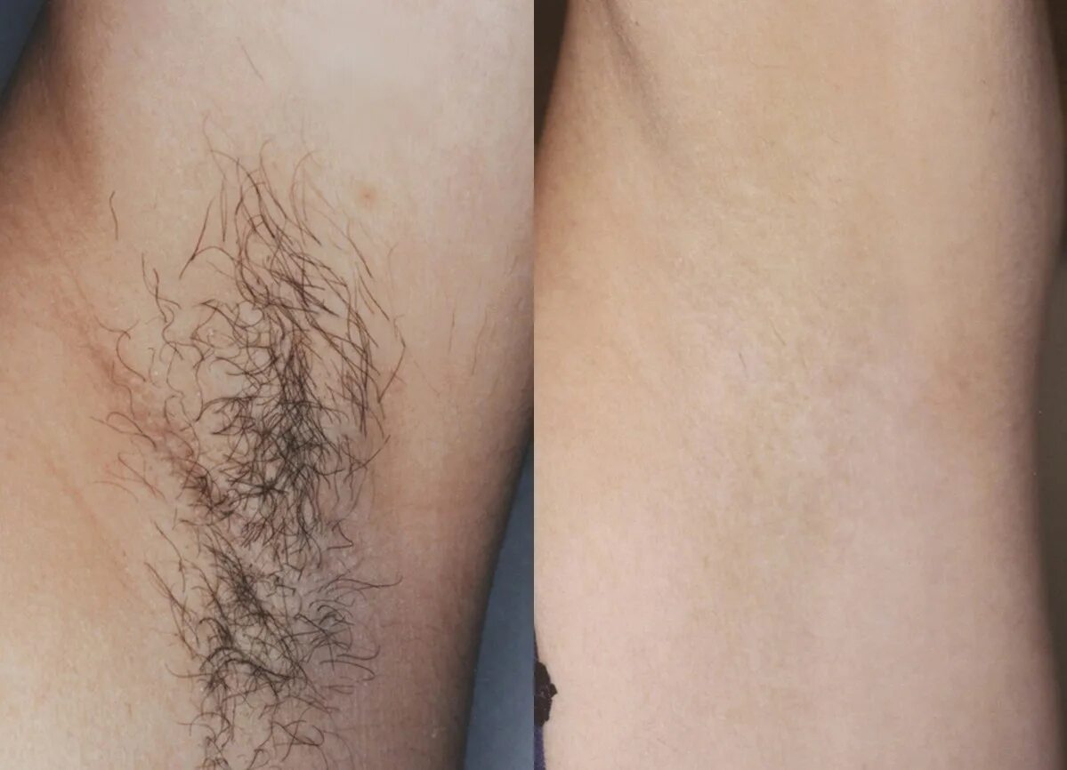 зона бикини после эпиляции. схема бритья лица. лазерная эпиляция интимной зоны женская. во сколько лет можно прыть ноги. бикини до и после шугаринга.