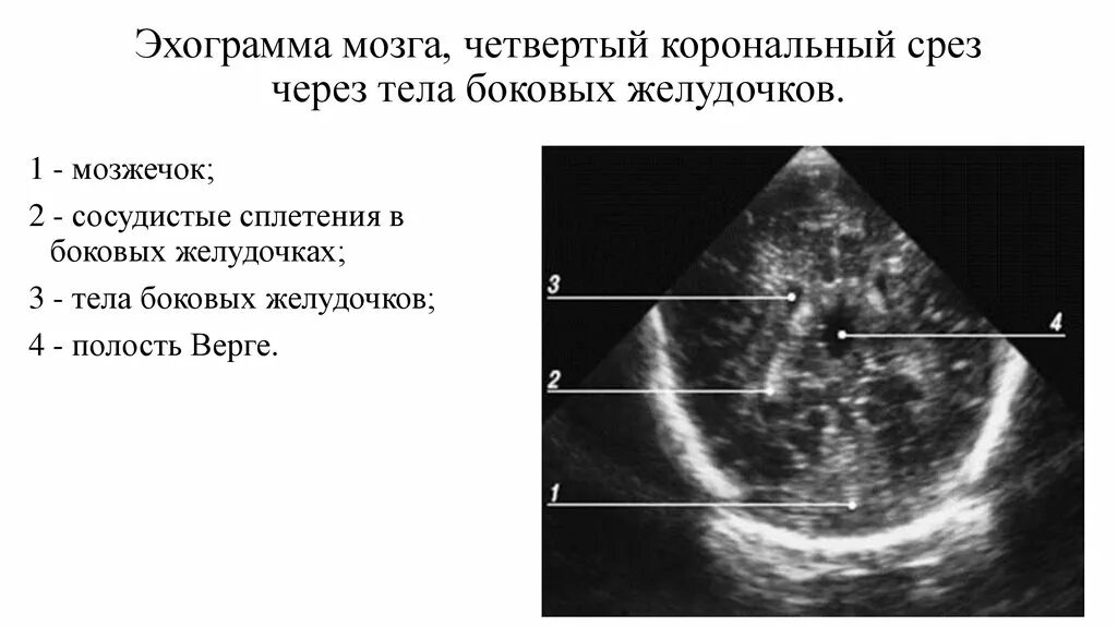 Нормы нсг. Нейросонография полость Верге. НСГ У новорожденных нормы. Ультразвуковое исследование головного мозга - нейросонография (НСГ). УЗИ головного мозга у новорожденных расшифровка норма таблица.