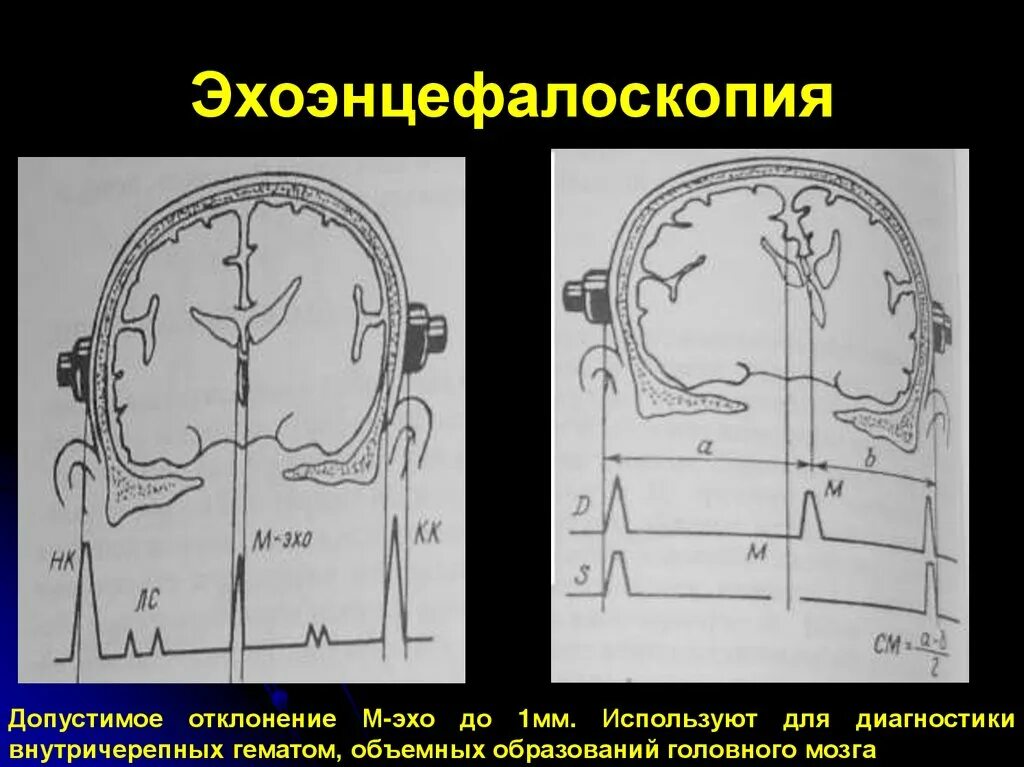 Эхоэнцефалоскопия. Эхоэнцефалография головы. Энцефалоскопия головного мозга. Эхоэнцефалоскопия норма. Эг что это за обследование