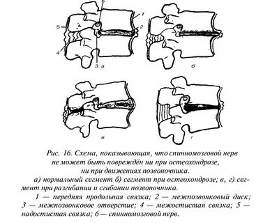 Остеохондроз схема
