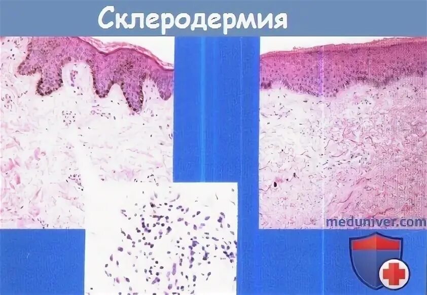 Pin on Lupus (SLE)