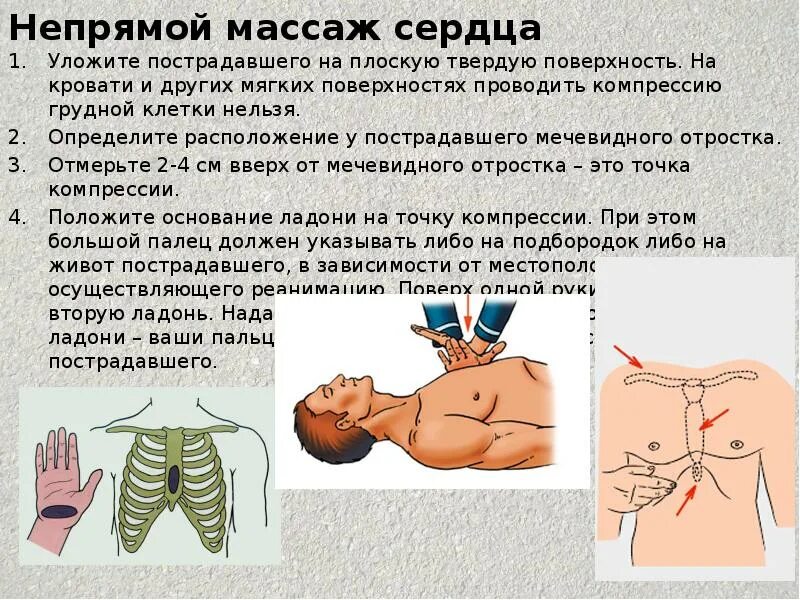 Как проводится непрямой массаж сердца. Первая помощь непрямой массаж. Непрямой массаж сердца схема. Непрямой массаж сердца алгоритм. Алгоритм проведения непрямого массажа сердца.