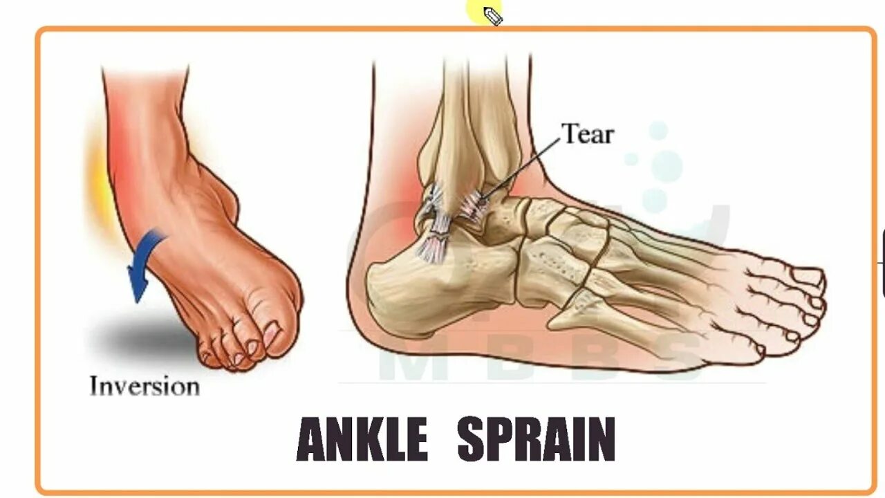 ORTHOPAEDICS- Ankle Sprain - YouTube