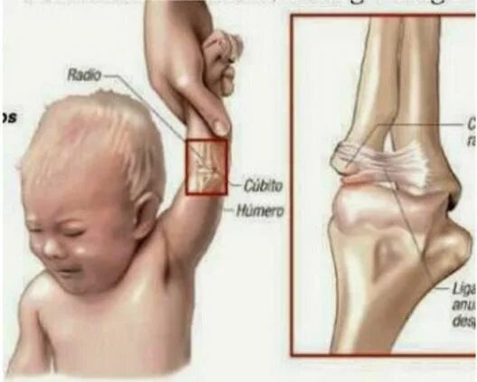 Подвывих локтевого сустава у ребенка. Подвывих руки у ребенка 3 года. подвывих локтевого сустава у ребенка 2 года.