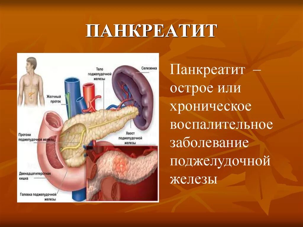 Заболевания поджелудочной панкреатит. Панкреатит биология 8 класс. Острый панкреатит поджелудочной железы. Острый панкреатит поджелудочная железа острый панкреатит. Заболевания поджелудочной железы биология 8.