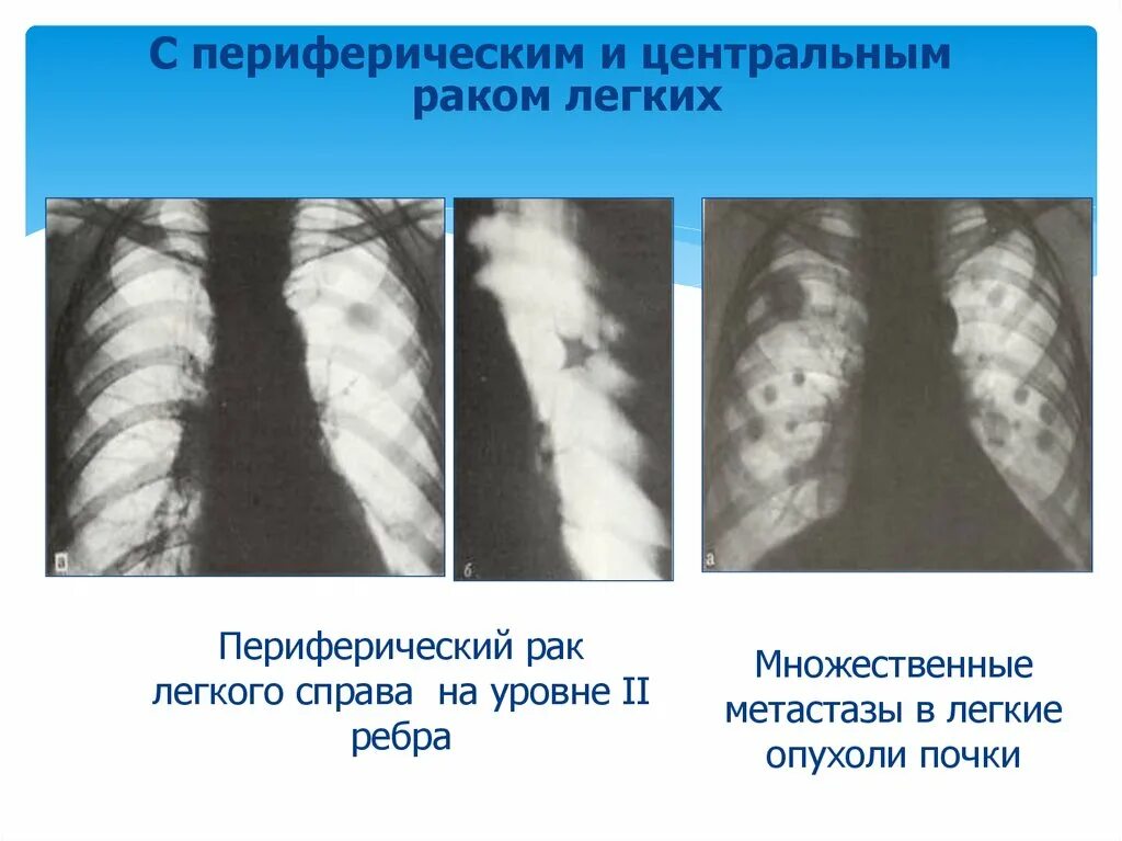 Периферические опухоли легких. Периферическая опухоль легкого. Периферическое новообразование в легких. Признаки метастаз в легких