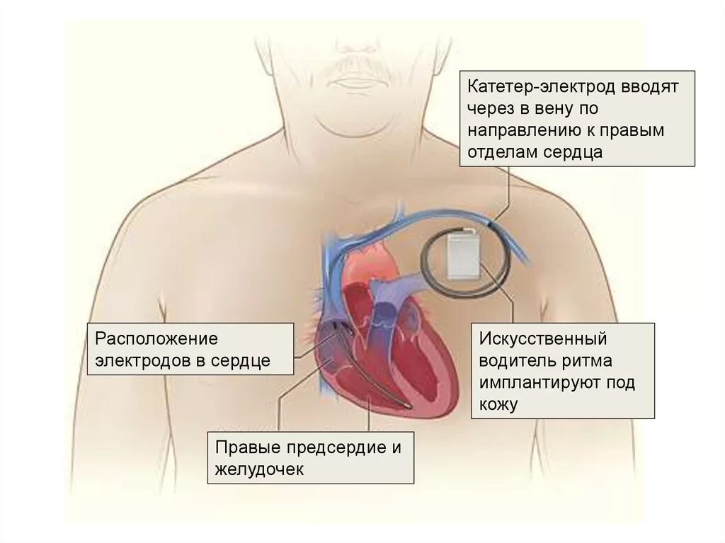 Замена клапана инвалидность