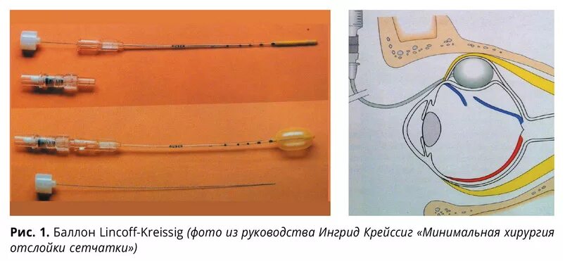 Пломбирование сетчатки. Баллонирование при отслойке сетчатки экстрасклеральное. Отслойка сетчатки баллонирование склеры. Транссклеральная криопексия сетчатки. Пломбирование отслойки сетчатки.