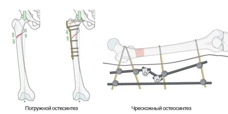 Для сращивания костей. Экстрамедуллярный остеосинтез. Остеосинтез перелома бедренной кости. Погружной чрескостный остеосинтез. Экстрамедуллярный остеосинтез голени.