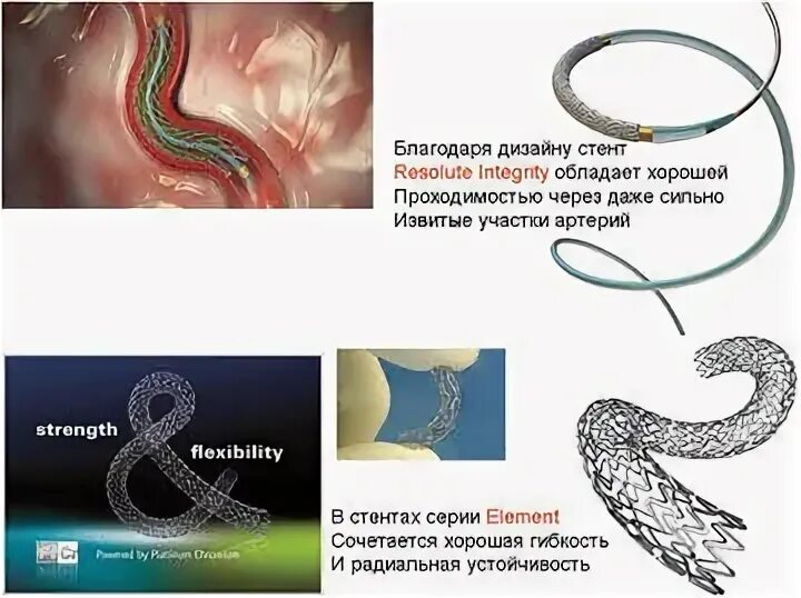 Лекарственный стент. Biomime стент. Biomime стент коронарный. Поколения стентов с лекарственным покрытием. Стент коронарный с лекарственным покрытием.