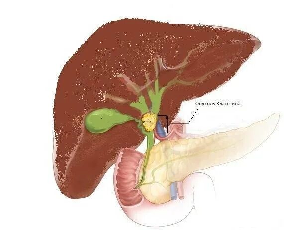 Отекает желчный пузырь. Опухоли внепеченочных желчных протоков. Холангиокарцинома желчных протоков. Опухоль печени клацкина.
