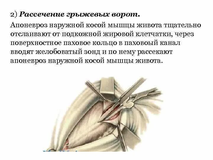 Рассечение термин. Рассечен ие гржевых ворот. апоневроз наружной мышцы живота. рассечение апоневроза наружной косой мышцы живота. апоневроз наружней косой мышцы.