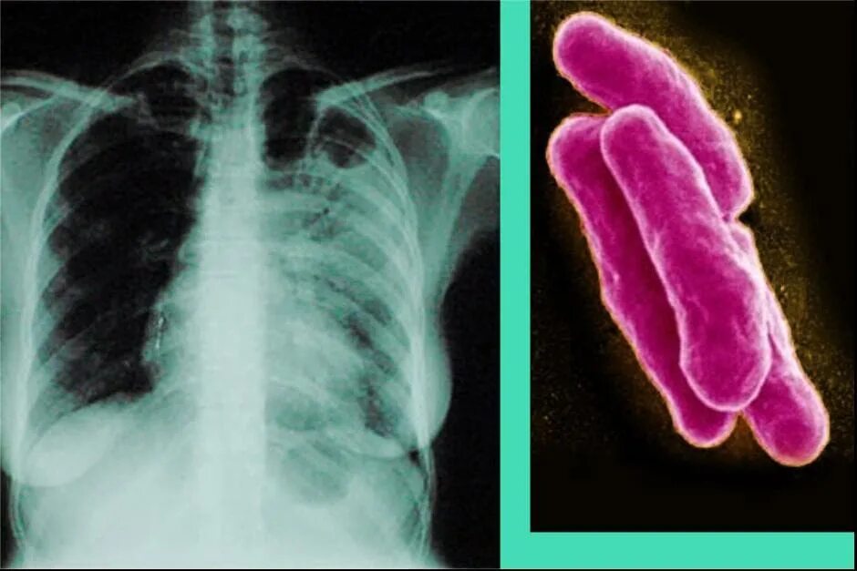 Микобактерия туберкулеза. Туберкулез tuberculosis