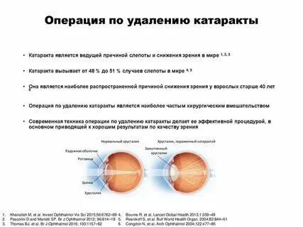 Удаления катаракты форум отзывы
