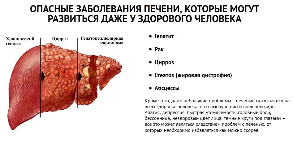 Чем опасна жировая печень. Опасные заболевания печени.