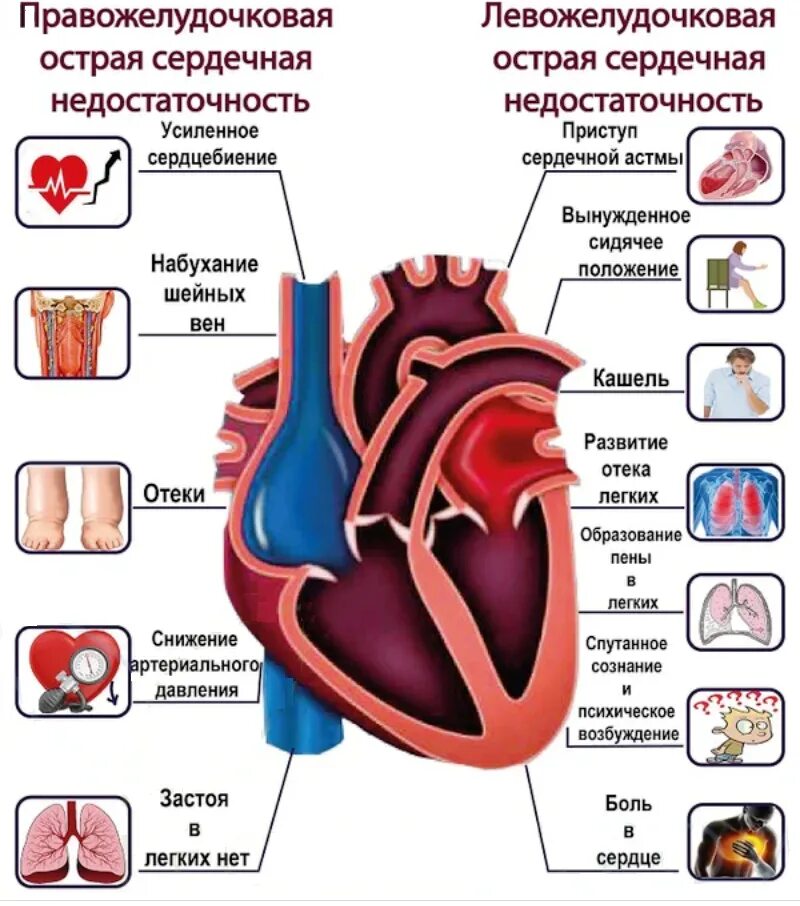 Сильное сердце что делать. Проявления острой сердечной недостаточности. Острая и хроническая сердечная недостаточность. Проявления застой серлечной недостаточностт. Симптомы острой и хронической сердечной недостаточности.