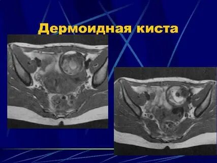 Киста картинка