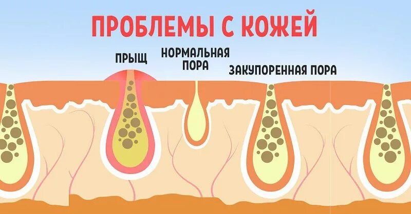 Причина пор. Закупоренная кожа лица. закупоривание поры на коже.