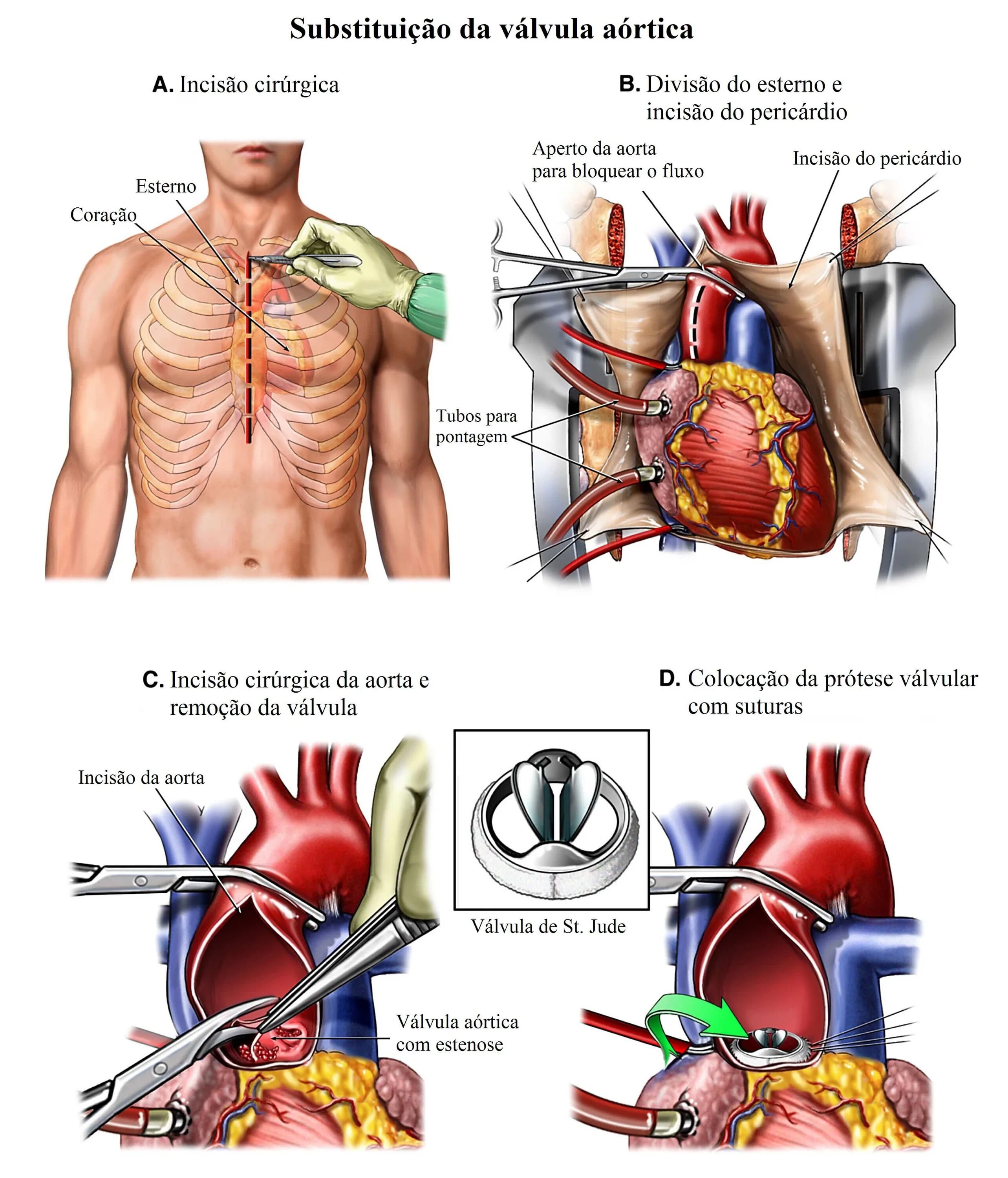 Инвалидность после замены клапана. Протез аорты и аортального клапана. Имплантация аортального клапана. Операция на открытом сердце.