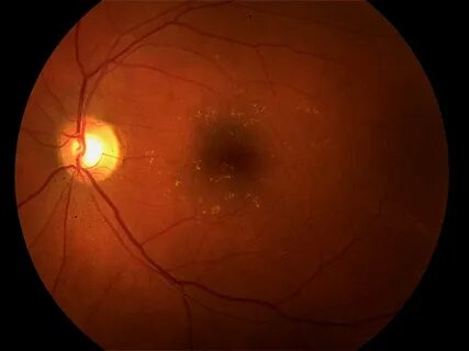 Age related macular degeneration