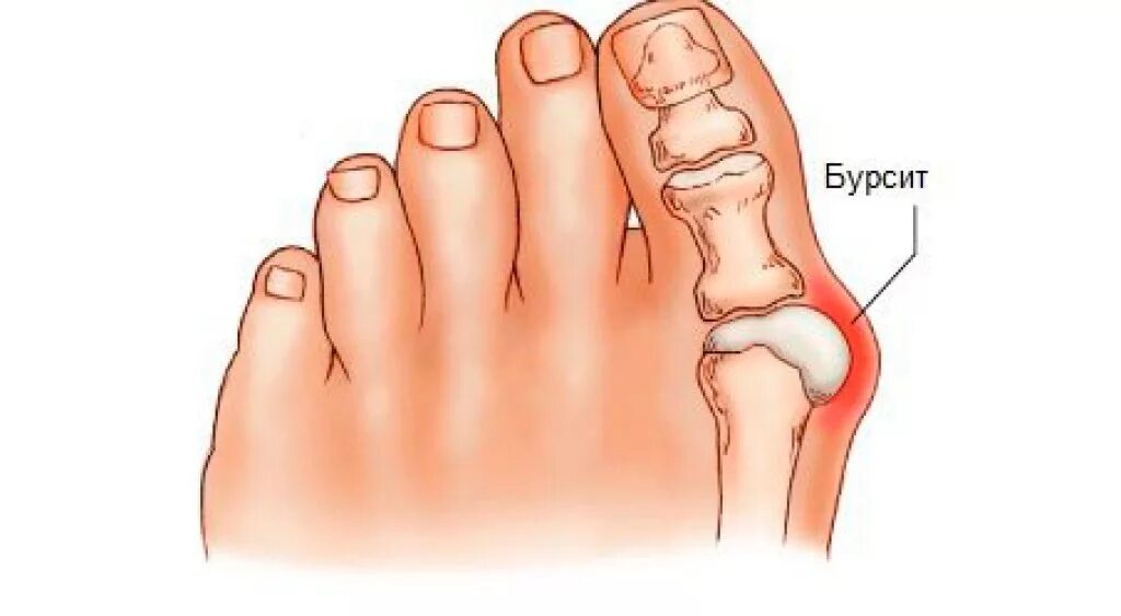 Почему болит кость пальца. Бурсит вальгусной косточки. Бурсит 1-го плюснефалангового сустава. Бурсит косточки большого пальца стопы.