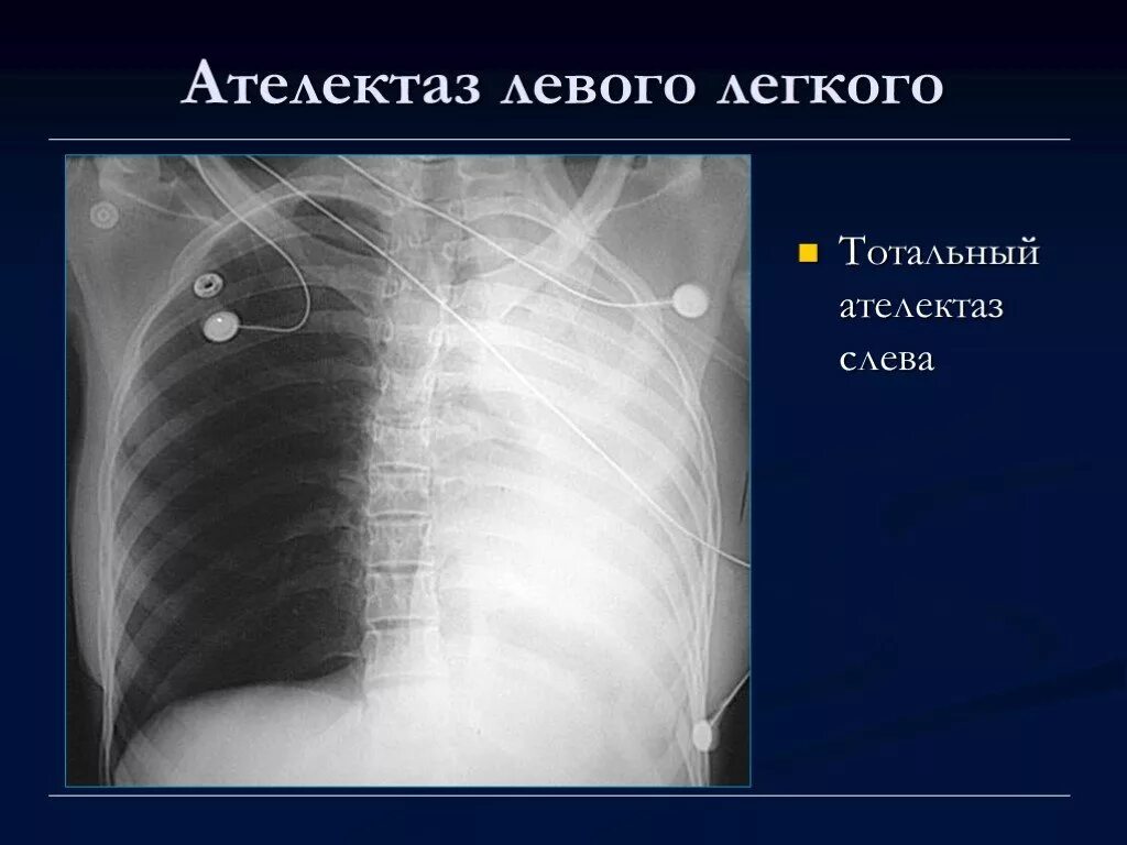 Левосторонний обтурационный ателектаз. Обтурационный ателектаз рентгенограмма. Ателектаз верхней доли рентгенограмма. Рентгенограмма Тотальный ателектаз. Почему уменьшается легкое