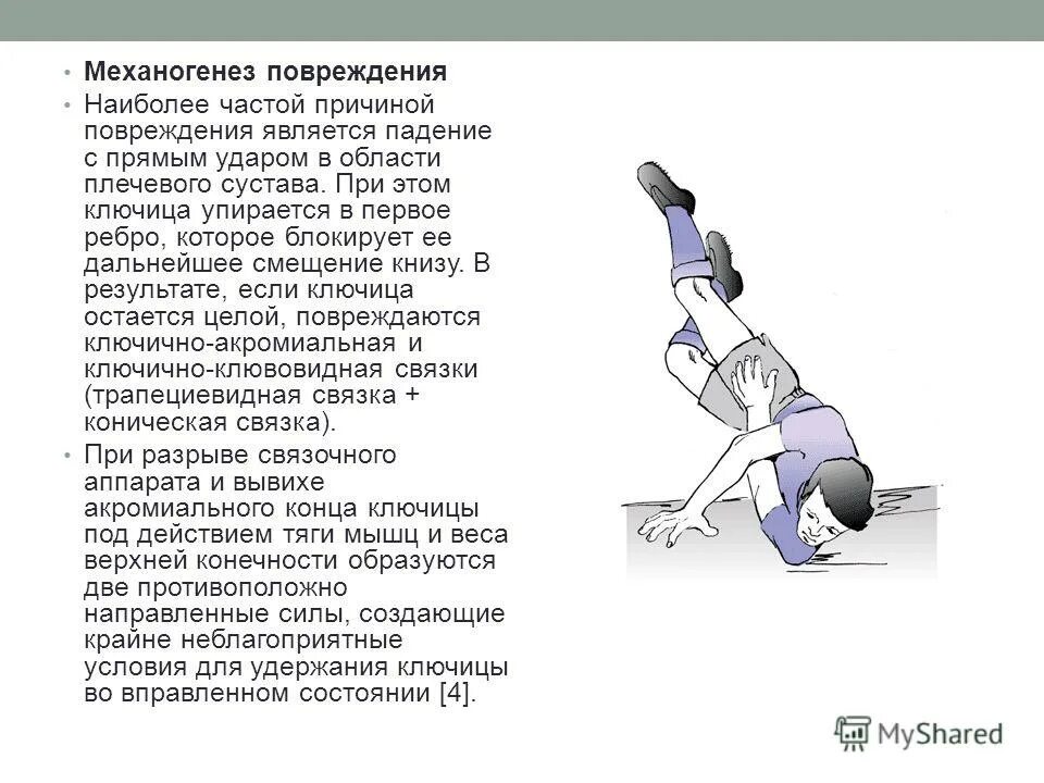 Ушиб плечевого сустава при падении симптомы. Ушиб плечевого сустава при падении симптомы. Классификация разрывов плечевого суставов. Закрытая травма плечевого сустава. Ушиб плечевого сустава при падении.