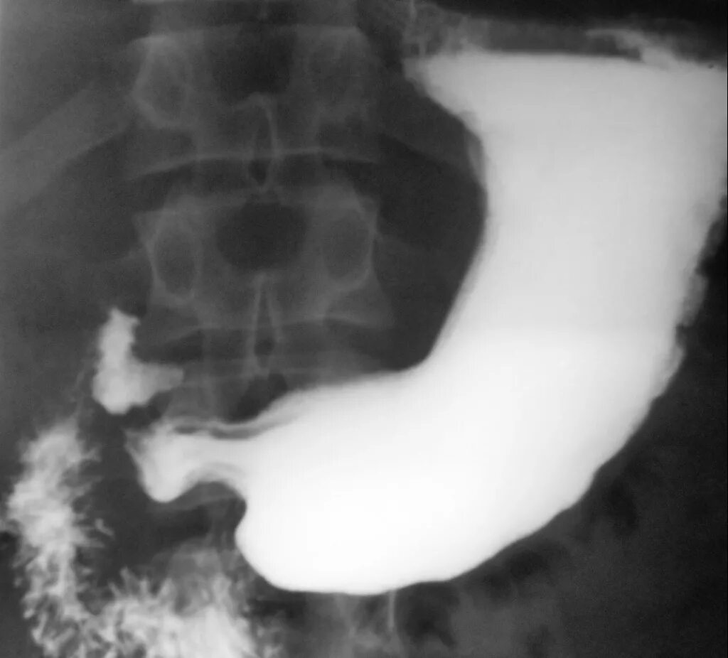 положение пациента при рентгенографии пищевода. анастомоз желудка рентген. рентген желудка с барием отзывы. дивертикул дна желудка на рентгене. рентген желудка с барием отзывы.