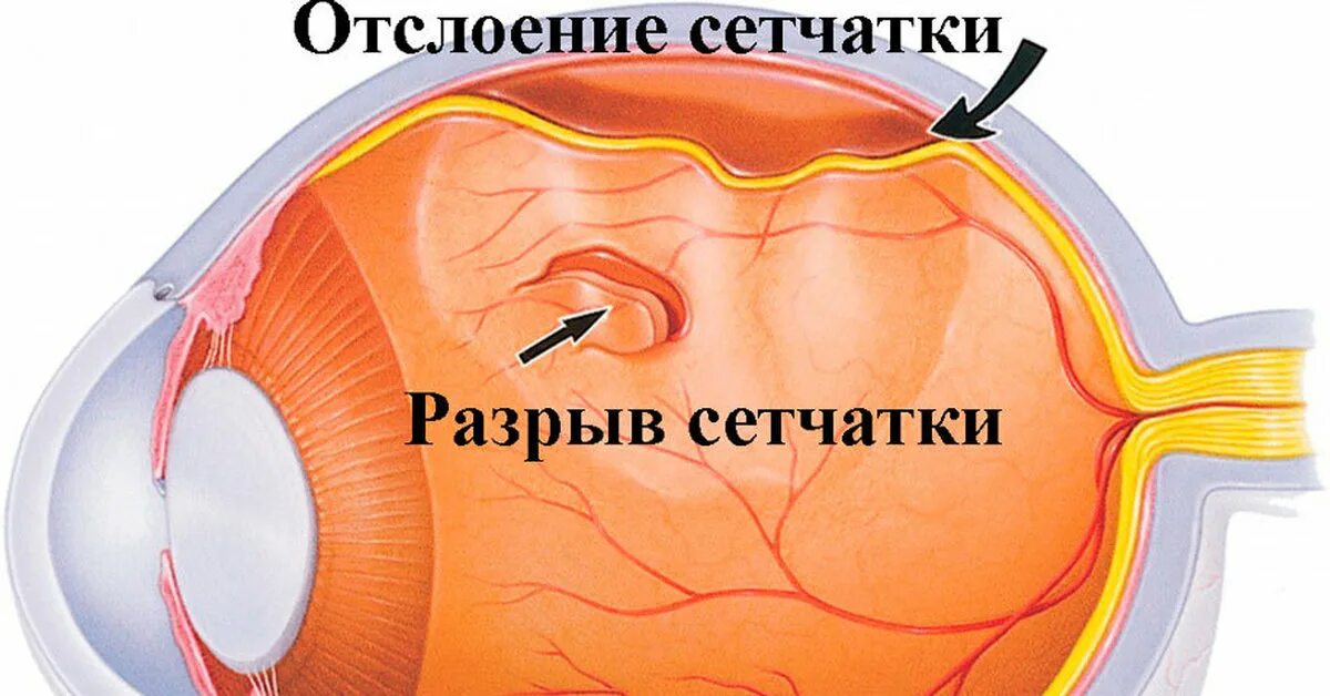 Пузыревидная отслойка сетчатки. Тракционная отслойка сетчатки глаза. Неопластическая отслойка сетчатки. Субтотальная отслойка сетчатки. Стекловидное тело операция