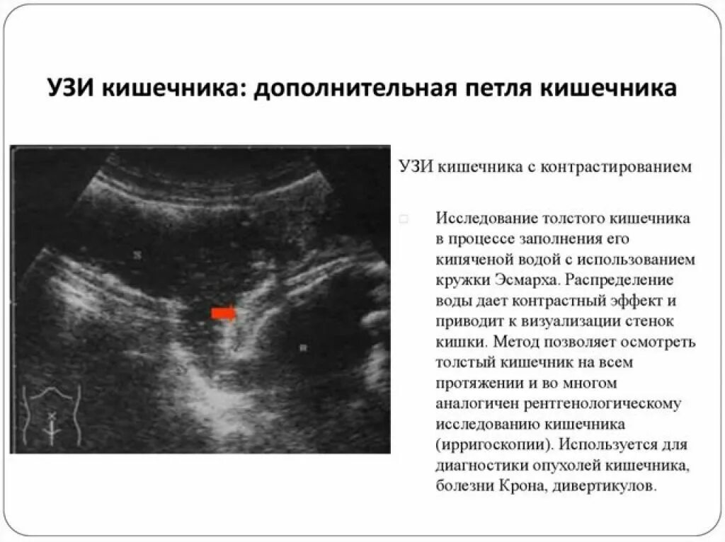 Как называется узи кишечника. Дивертикулит сигмовидной кишки на узи. Узи кишечника (эндоректальная ультрасонография). Образование толстого кишечника на узи. Узи толстой кишки норма.