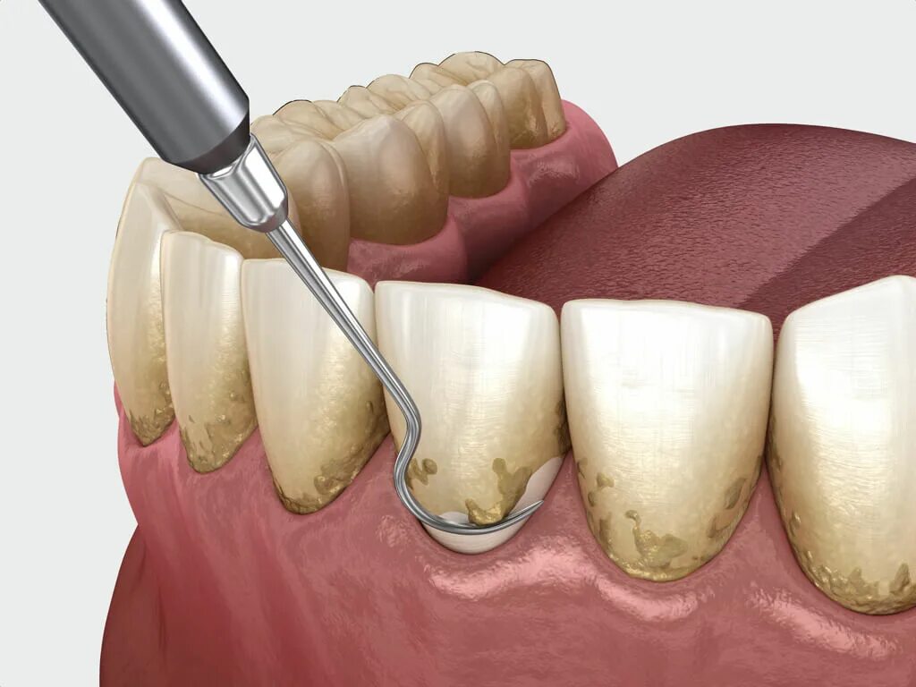 Кюретаж десневых карманов. Пародонтальный карман кюретаж. Скейлинг пародонтальных карманов. Как чистить десна