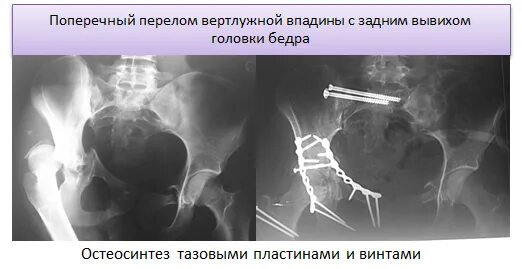 Оперативное лечение перелома костей