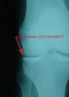 Образование остеофитов