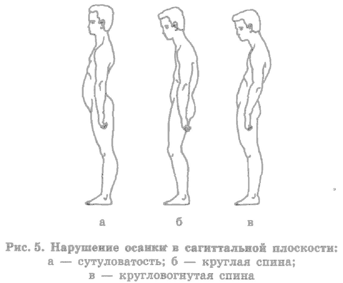 Типы нарушений осанки сутулость. Дефекты осанки. Вогнуто круглая спина. Типы нарушения осанки по штаффелю. Тип осанки кругловогнутая спина.