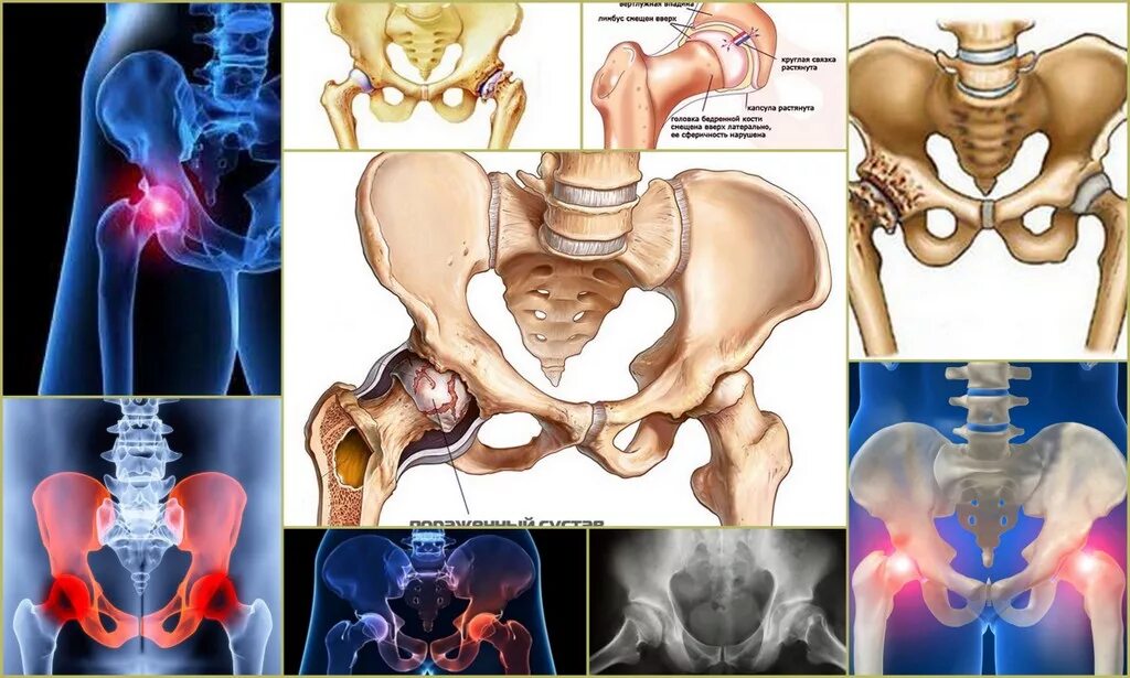 Посттравматический коксартроз. Коксартроз тазобедренного сустава. Коксартроз (артроз тазобедренного сустава). Диспластический коксартроз степени. Медицина суставы тазобедренный