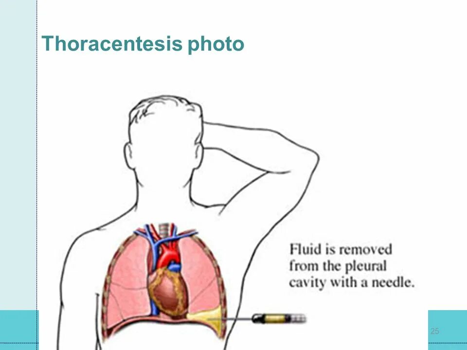 откачивают жидкость из легких. попадание жидкости в легкие. санация и дренирование плевральной полости. спонтанный пневмоторакс пункция. как откачивают жидкость из легких при пневмонии.