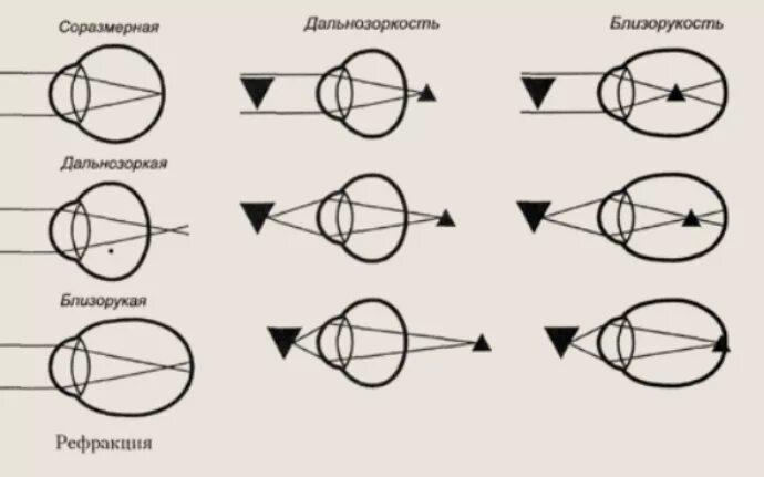 Ход лучей близорукость и дальнозоркость. Схемы рефракции при нормальном зрении. Близорукость схема глаза. Схема преломления лучей света хрусталиком глаза.