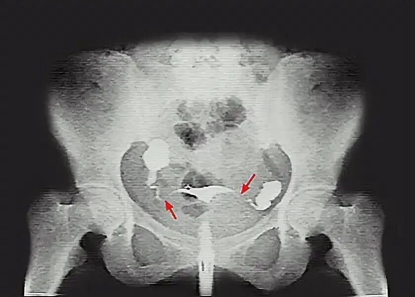 Непроходимость труб лечится. Гистеросальпингография двурогая матка. Гистеросальпингография непроходимость. Маточные трубы облитерированы что это такое. Врожденная непроходимость маточных труб.