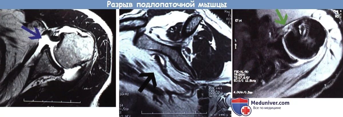 Повреждение сухожилия подлопаточной мышцы. Сухожилие подлопаточной мышцы мрт. Разрыв подлопаточной мышцы мрт. Повреждение сухожилия подлопаточной мышцы на мрт. Частичный разрыв сухожилия подлопаточной мышцы.