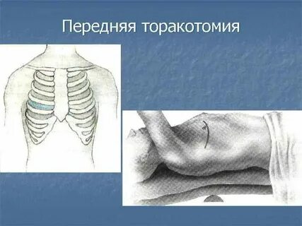 Торакотомия