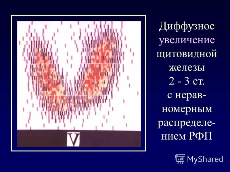 Сцинтиграммы щитовидной железы. Поглощение РФП щитовидной железы. Сцинтиграфия щитовидной железы РФП. Слабый диффузный