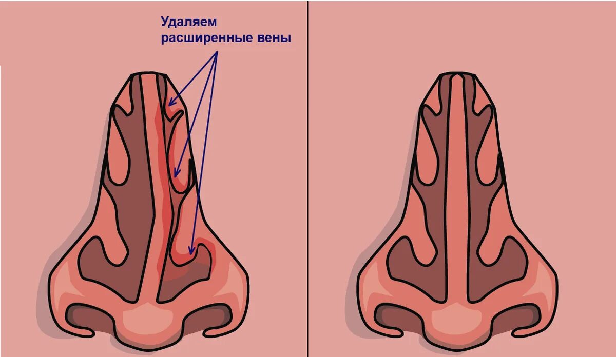 Вазомоторный ринит перегородки носа. Искривление носовой перегородки вазомоторный ринит. Вазомоторный ринит септопластика. Вазомоторный ринит деформация перегородки. Перегородка носа без операции