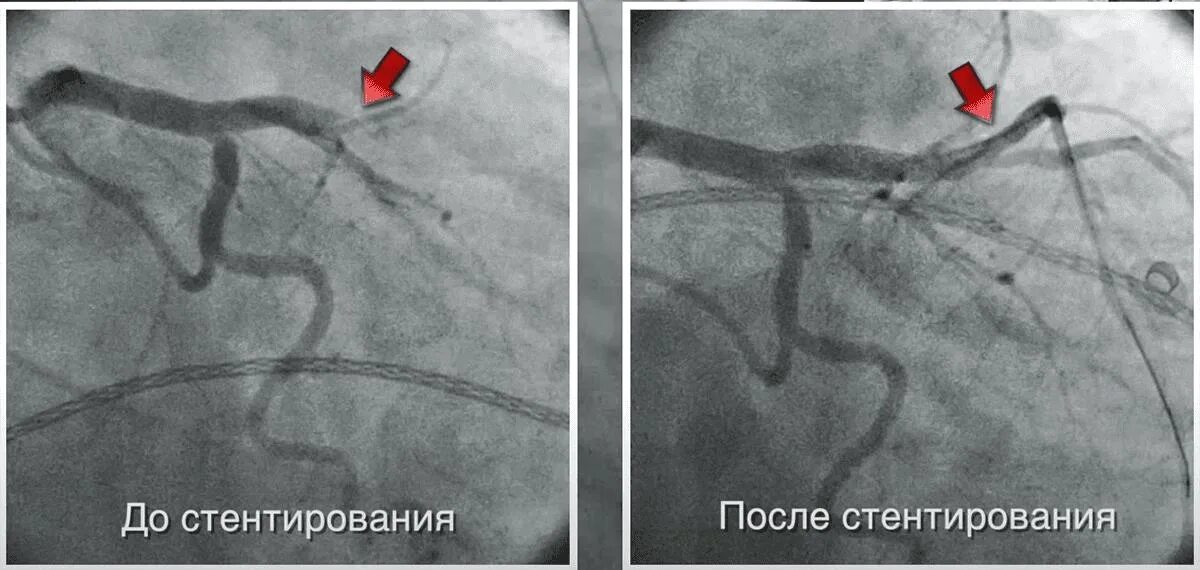 После стентирование самолет. Стентирование бедренной артерии. Стентирование коронарных артерий. Стентирование вен нижних конечностей. Стентирование периферических артерий.